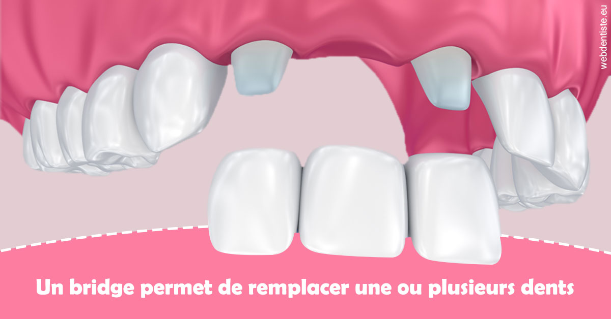 https://www.centredentairedeclamart.fr/Bridge remplacer dents 2