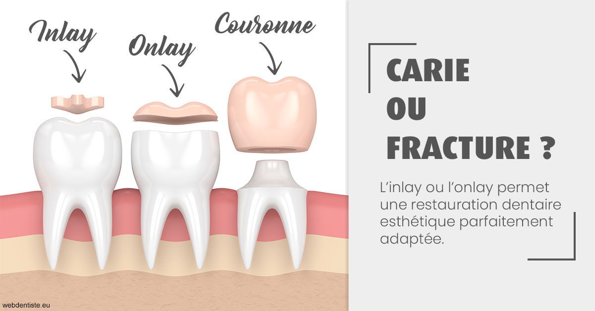 https://www.centredentairedeclamart.fr/T2 2023 - Carie ou fracture 1