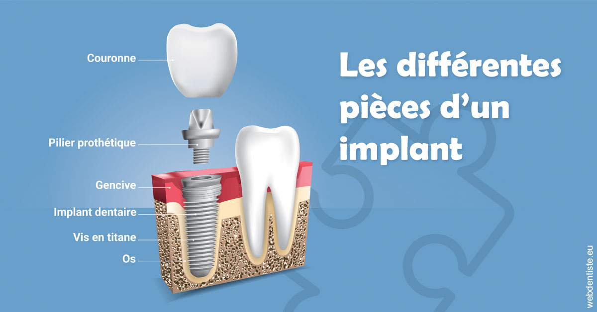 https://www.centredentairedeclamart.fr/Les différentes pièces d’un implant 1